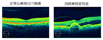 黄斑変性の初期兆候は何ですか?