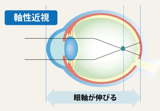 眼軸の長さが伸びる