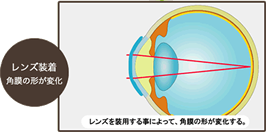 レンズ装着：角膜の形が変化